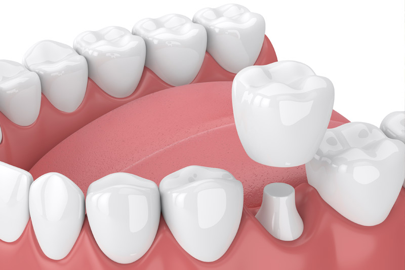 Dental Crowns in South Euclid