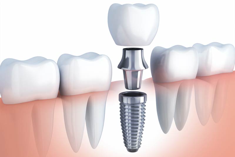 Implants Dentist in South Euclid