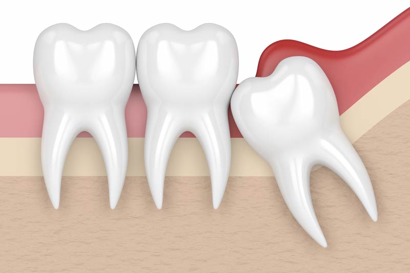 Wisdom Tooth Removal in South Euclid